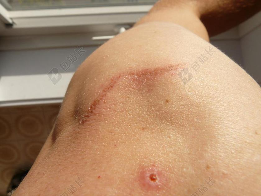 疤痕 伤口 臂 肩 皮肤 人的 人