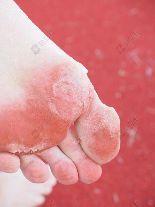 鞋底的脚 角膜 脚 泡沫 过期 皮肤 磨损 疼痛 伤口