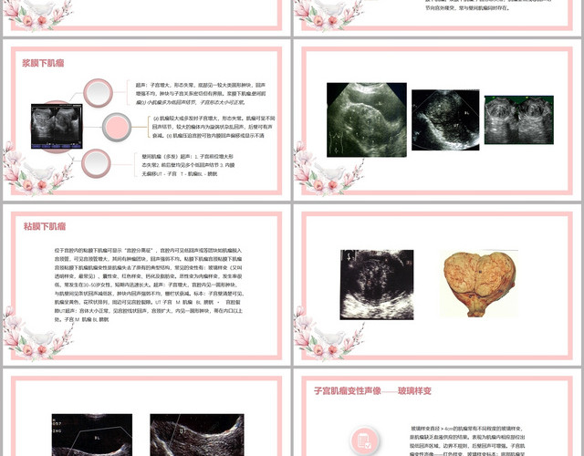 粉色手绘清新风子宫肌瘤的超声诊断子宫肌瘤护理查房PPT模板