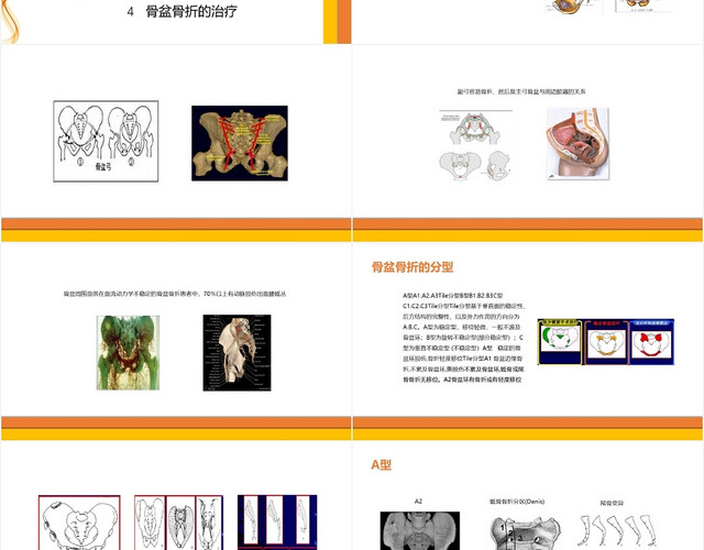 橙色曲线风骨盆骨折的分型及治疗多发骨盆骨折护理查房PPT模