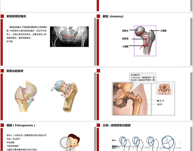 红色扁平股骨颈骨折护理查房股骨颈骨折PPT模板