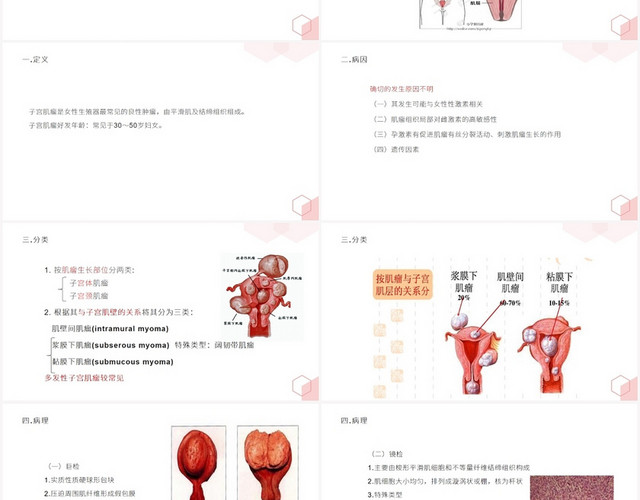 粉色卡通子宫肌瘤护理查房子宫肌瘤PPT模板