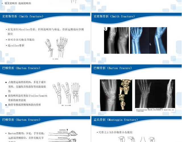 蓝色上肢骨折常见类型上肢骨折护理查房