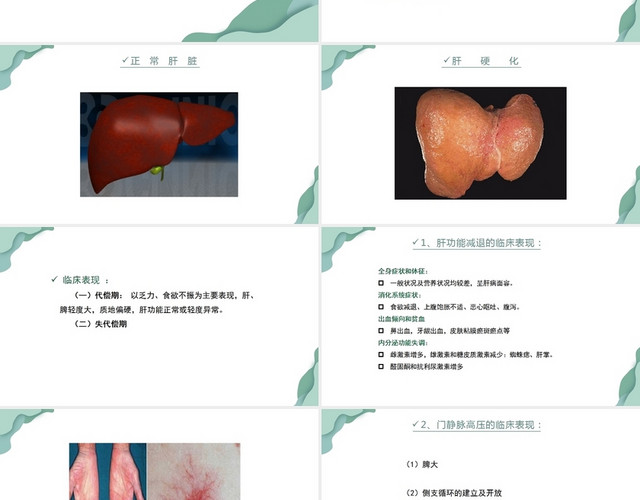 绿色肝硬化腹水患者护理查房肝硬化患者护理查房