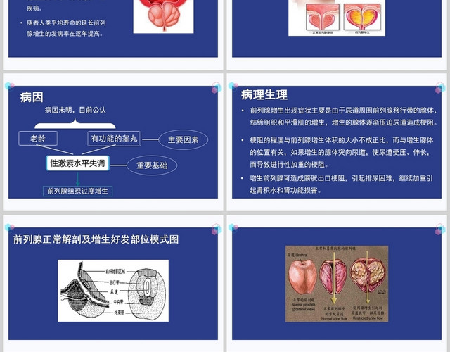 蓝色护理查房前列腺增生