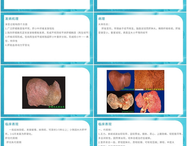 蓝色商务风肝硬化患者护理查房肝硬化PPT模板