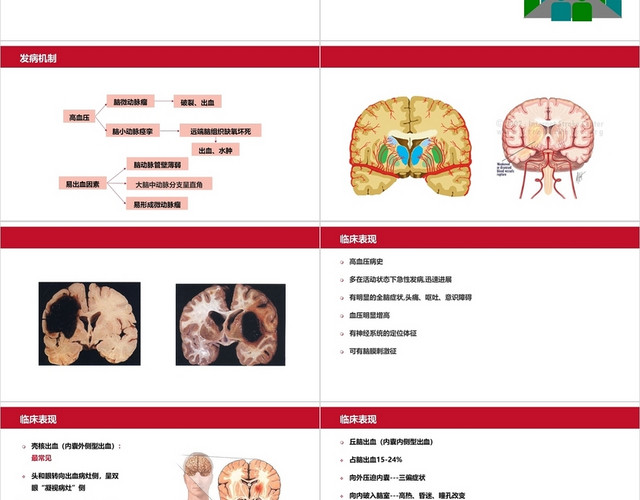 白红色简约风脑出血护师培训PPT模板
