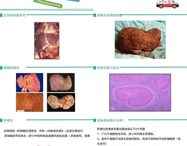 绿色肝硬化病人护理查房肝硬化患者护理查房