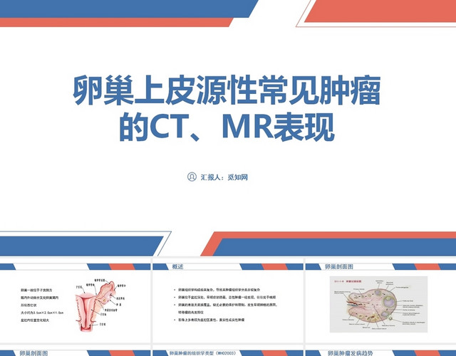 蓝色卵巢癌护理查房PPT模板