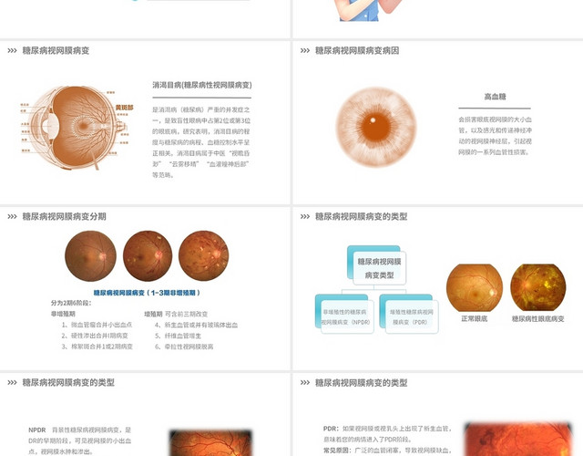 靛蓝色简洁糖尿病视网膜病变患者护理查房PPT模板