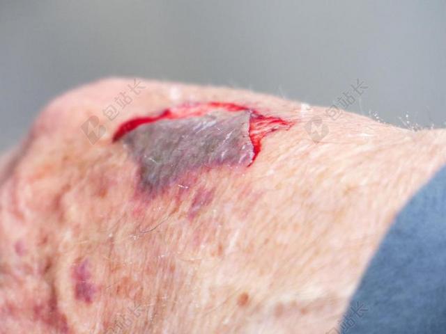 手 损伤 伤口 血 裂纹 血腥的 伤人 事故 皮肤 瘿