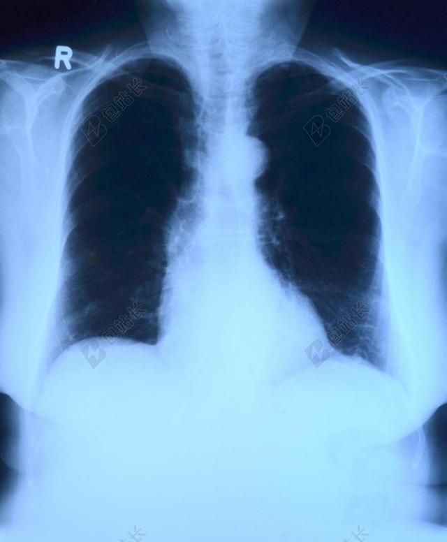 黑白医疗健康肺部照片背景图片