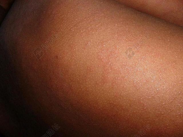 生物皮肤病麻疹局部特写背景图片