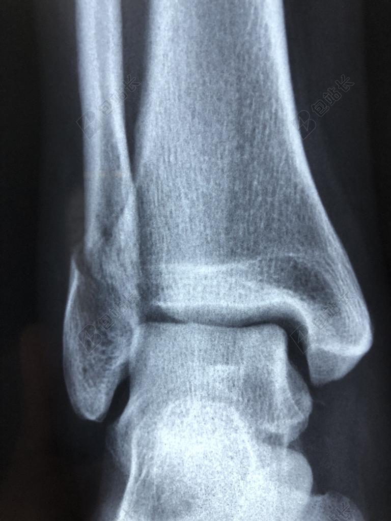 黑白的X光照片背景图片