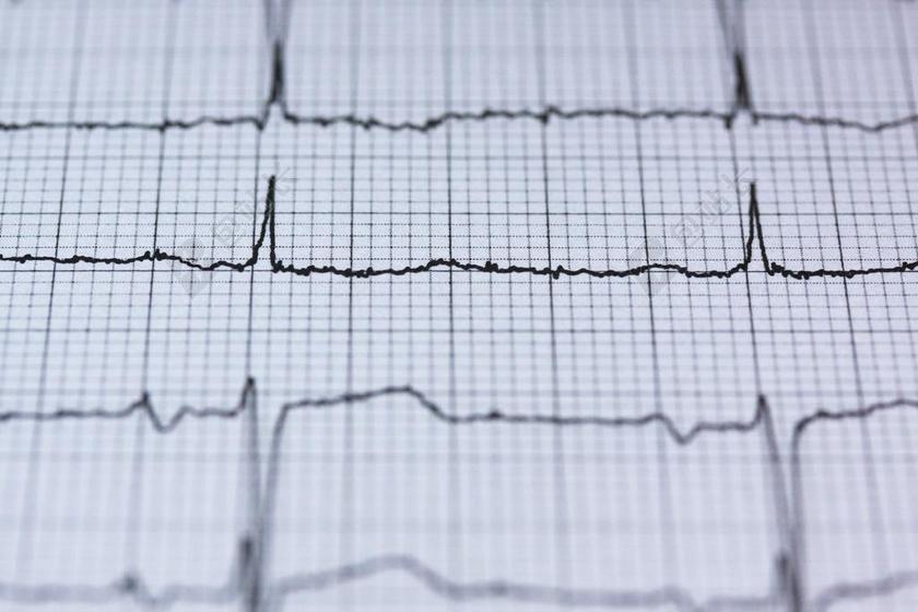 心电图 医疗 心跳 心脏 频率 曲线 脉冲 活 保佑你